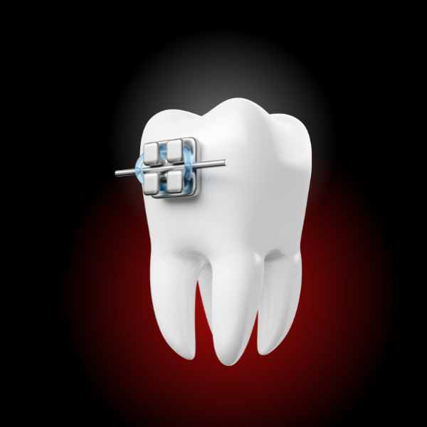 aparat dentar metalic pret, rasmindent.ro