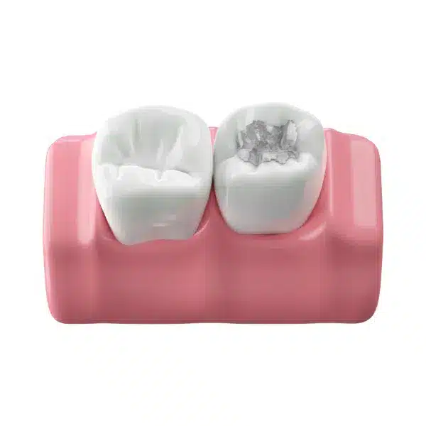 obturatie dentara, rasmindent.ro