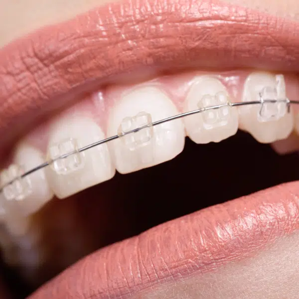 tratamente stomatologice, aparat dentar ceramic, rasmindent.ro