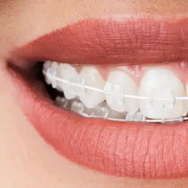 tratamente stomatologice, aparat dentar safir, rasmident.ro