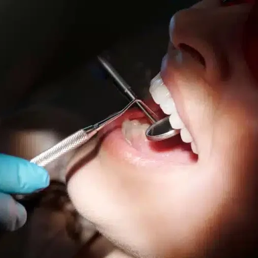 tratamente stomatologice, chistectomie dentara, rasmindent.ro