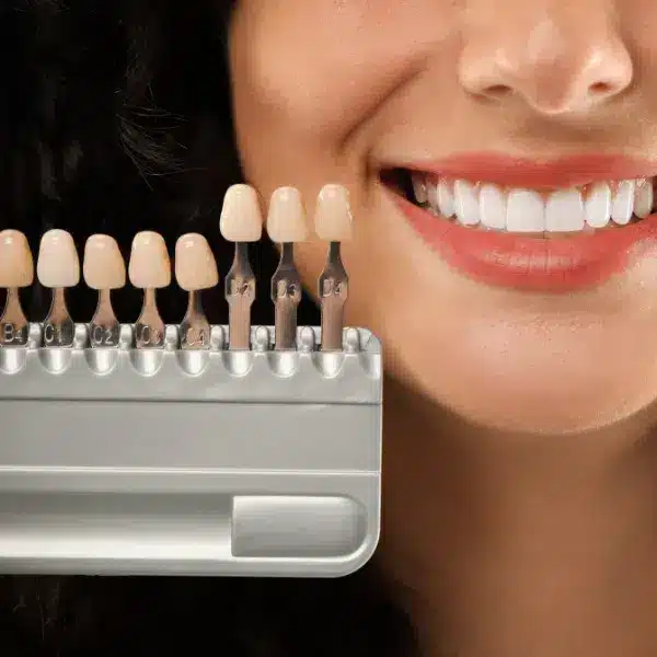 tratamente stomatologice, fatete dentare, rasmindent.ro