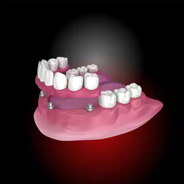 tratamente stomatologice, implant bredent, rasmindent.ro