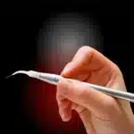chirurgie dentara, chistectomie dentara, rasmindent.ro