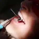 protetica dentara, cimentare dentara, rasmindent.ro