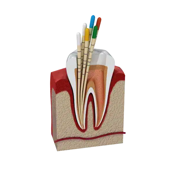 endodontie, tratament de canal, rasmindent.ro